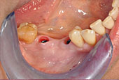 Widoczne implanty zębowe