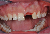 Lack of left central incisor tooth