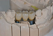 Bridge on implants on a laboratory model.