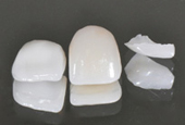 Full ceramic crowns and micro-felts