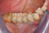 Cemented bridge inside the oral cavity.