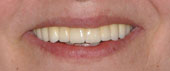 Permanent work in Patient’s mouth. 