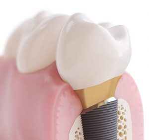 implant zębowy - korona zębowa