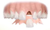 Odłączana proteza pojedynczego zęba zamontowana na klamrze.