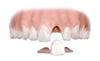 Bridge attached to the enamel.